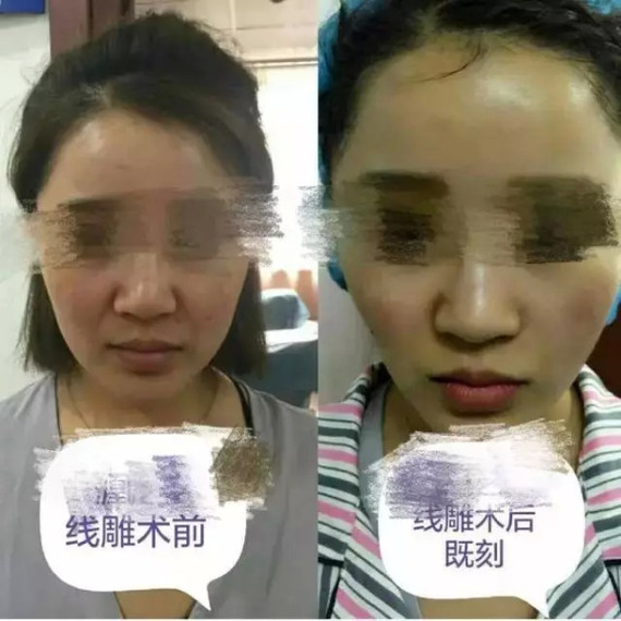 【医美科普】线雕提升18大问题衰老是人一生中不可避免事情之一。“线雕”的_圈子-新氧美容整形