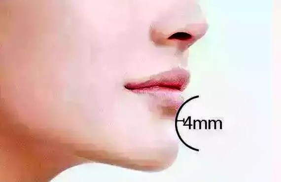 2,美人窝  下唇与下巴之间有较明显的美学凹陷 标准颏唇沟深约4mm