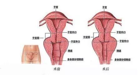 女性阴道干涩是什么原因?