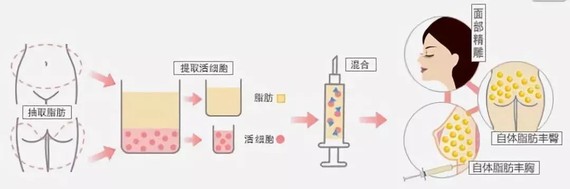 自体脂肪移植的是自身的脂肪颗粒,作为自体组织,不会产生免疫反应和排