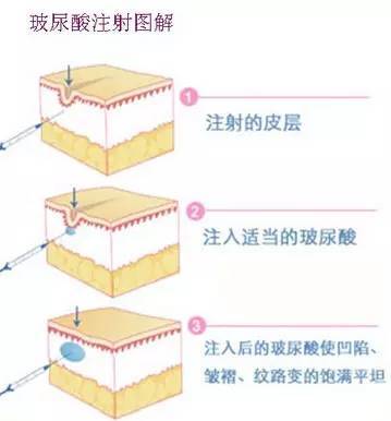水光注射用的玻尿酸和注射隆鼻用的玻尿酸是一样的吗?水光注射用的玻尿酸和注_圈子-新氧美容整形