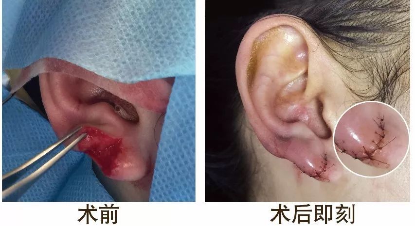 最后附~外伤性耳缺损急诊美容缝合术后即刻案例一枚