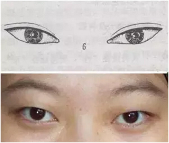 如果你的眼睛是吊梢眼,双眼皮 开眼角可完美改善
