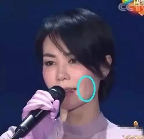 逆龄天后王菲 也是线雕的受益者 线雕作用 治疗皱纹 脸部(鱼尾纹