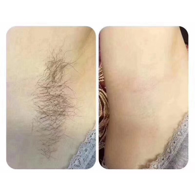 【脱腋毛】脱腋毛 1次 ,808半导体冰点无痛脱毛净肤/脱毛更彻底/年卡