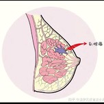 一:至少80%的女性都是"乳腺无知者"据乳腺科多年医生说