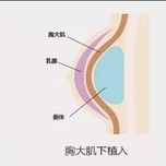 胸部悬吊术怎么做的