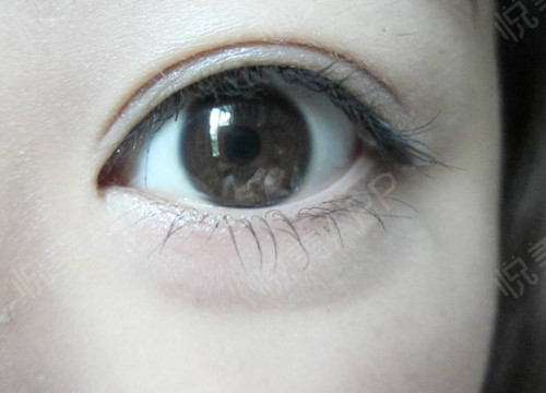 割双眼皮手术哪里结果好?很多求美者都希望自