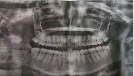 j's'j智齿，又称之为第三磨牙，智慧牙，从前往后数的第八颗牙，一般在1_圈子-新氧美容整形