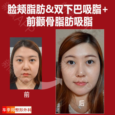 【面部吸脂】脸颊吸脂 双下巴吸脂 前颧骨脂肪吸脂 13700