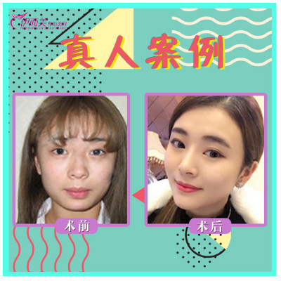 【膨体垫下巴】膨体下巴 颏肌释放术,解决下巴后缩,下巴短小,下巴没有