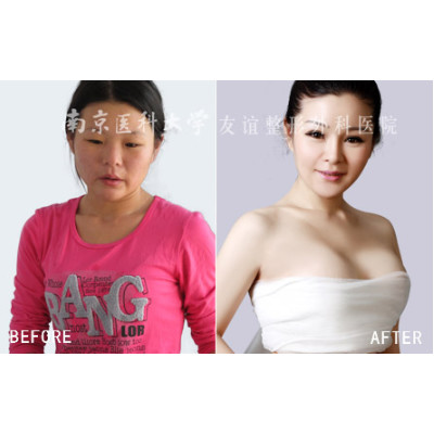 400cc假体效果图,泰国1050cc假体隆胸 【假体隆胸】公立三级整形外科医院 假体浪漫情怀水滴
