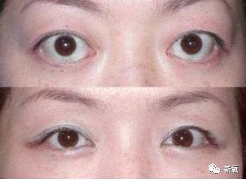 从而造成眼球后缩的效果,这种手术方法,适合于眼球突出较为严重的案例