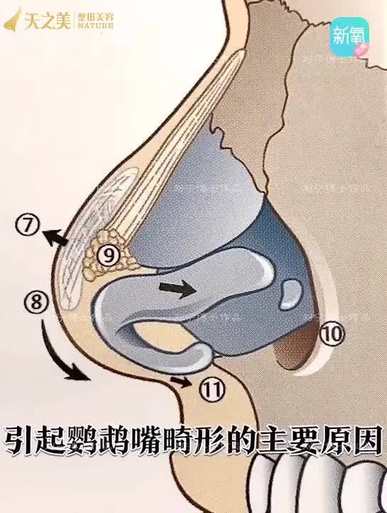 00鹦鹉鼻的具体原因