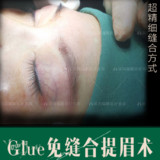 【切眉术】福雅glue免缝合提眉术 免拆线无需缝合 隐形切口 紧致眼周