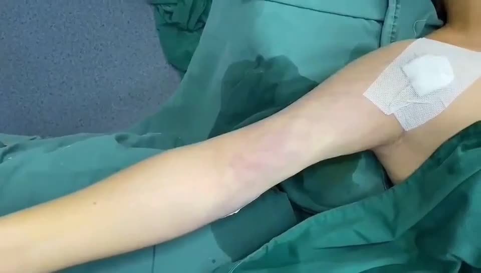 手臂环吸术后即刻吸脂不仅变瘦还可以收紧皮肤01