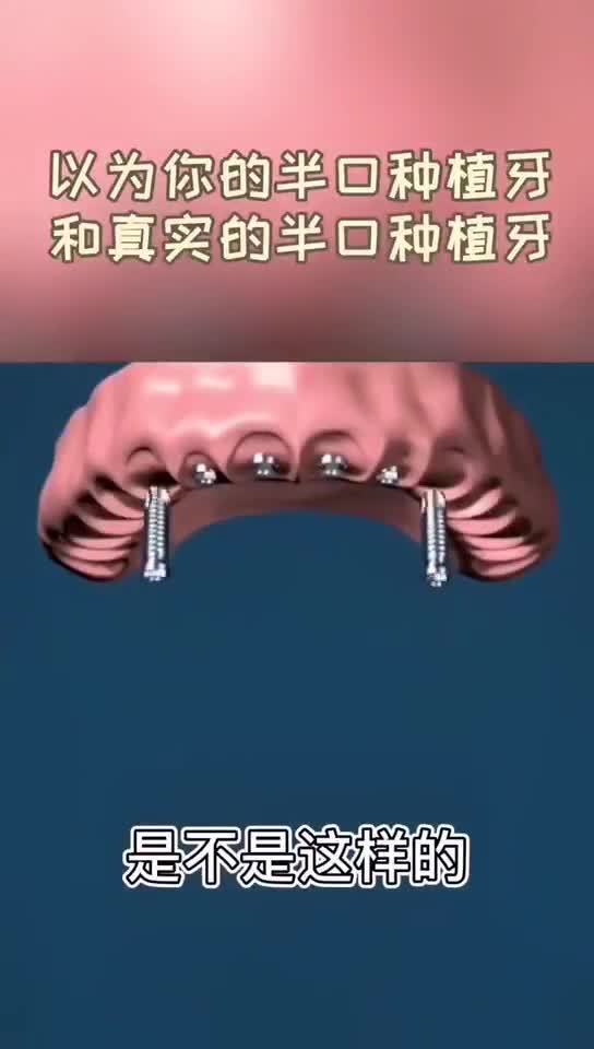 你以为的半口种植牙和真实的半口种植牙