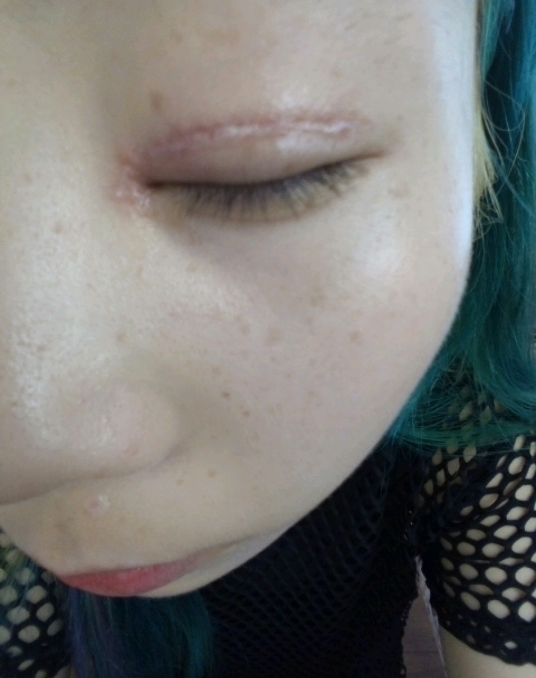 疤痕增生了怎么办啊?很急啊