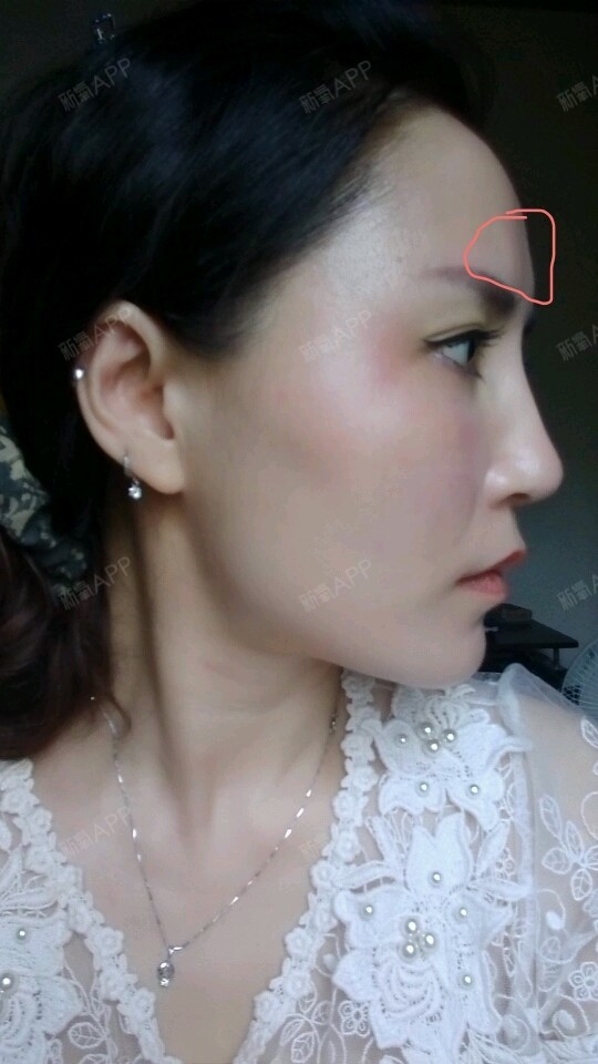 还在继续吸收,额头还是凹凸不平,两年前在别的医院做_圈子-新氧美容