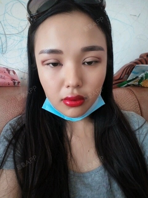 双眼皮加开眼角,半永久眉毛还有漂唇第一天肿得厉害,期待恢复