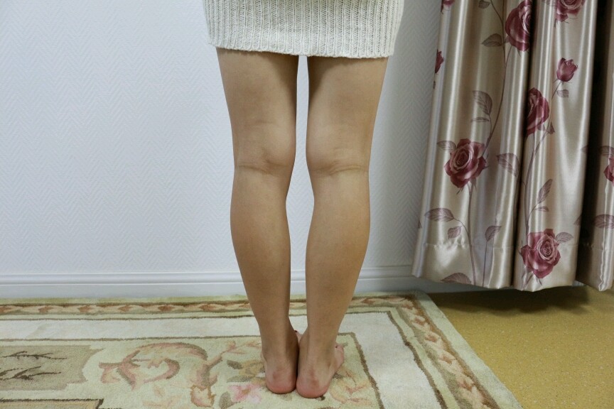术后当自强 | 注射肉毒素瘦小腿 | 美体塑形 | 小腿吸脂 | 国内整形