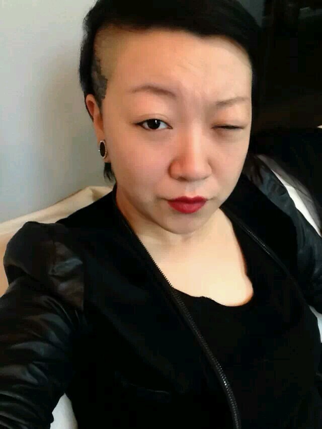 松弛下垂肿眼泡和下垂选择全切还是线雕眼皮下垂怎么自然恢复大肿眼泡