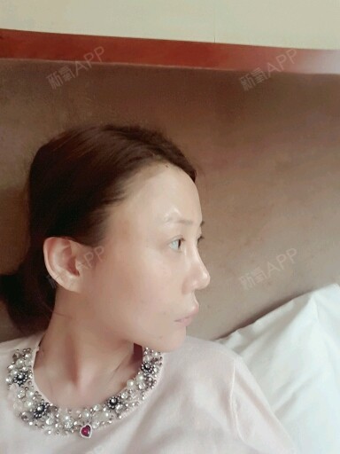 额头的凹凸不平能看的出来不啊啊～好纠结呢～为啥没有_圈子-新氧美容