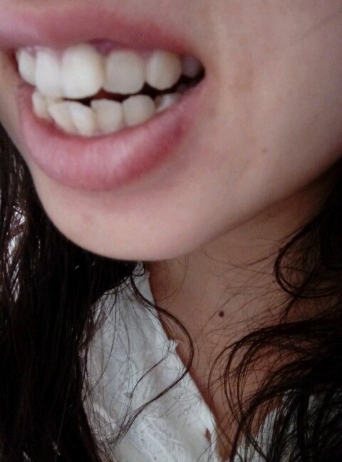 颌面矫正手术是个笼统的说法,具体分为上颌前