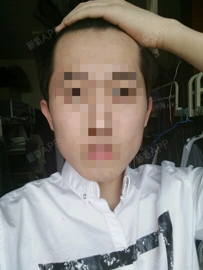 男生,腮帮子很大,本身脸就很长了,既想瘦脸又想下巴棱角分明,咬肌