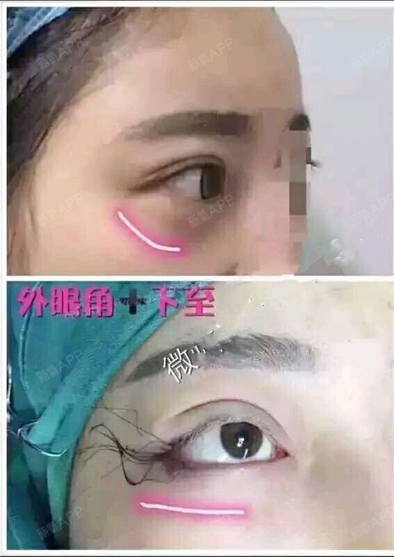 外眼角 下至