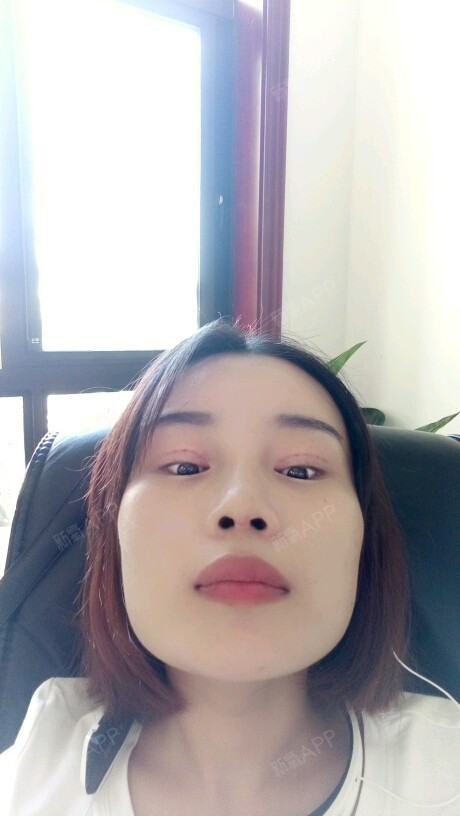 刘婷_330009膨体隆鼻术后第11天美丽日记_新氧整形