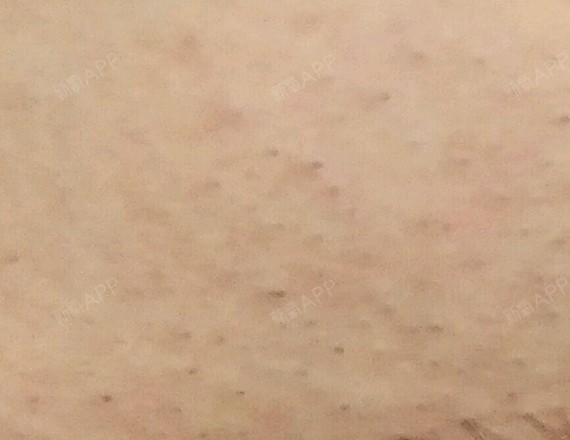 新氧- joy1989 | 激光脱毛 | 术后当自强 | 国内整形 | 比基尼线脱毛