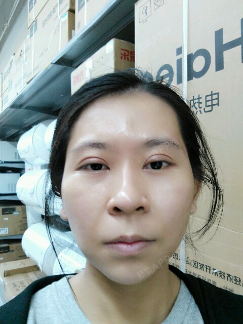 嘟嘟大自体脂肪全脸填充第39天美丽日记-新氧