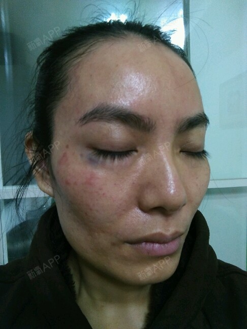 刚打完敷完面膜护士什么没给我清理一下,我脸都 ...