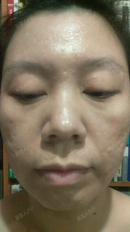 术后七天,看不出才做过高能量飞梭雷射完全没有反黑的