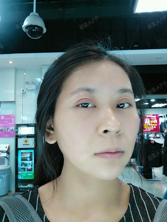 嘟嘟大自体脂肪全脸填充第74天美丽日记-新氧