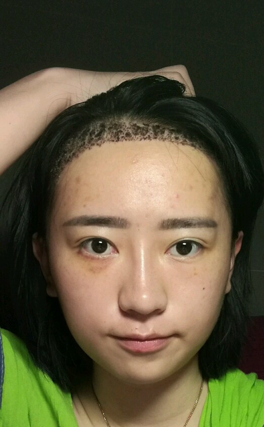 种植发际线
