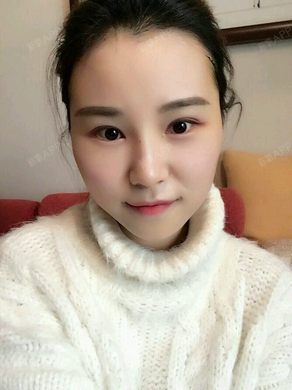 这张是我术后第4天的时候,脸上还是清黄色的