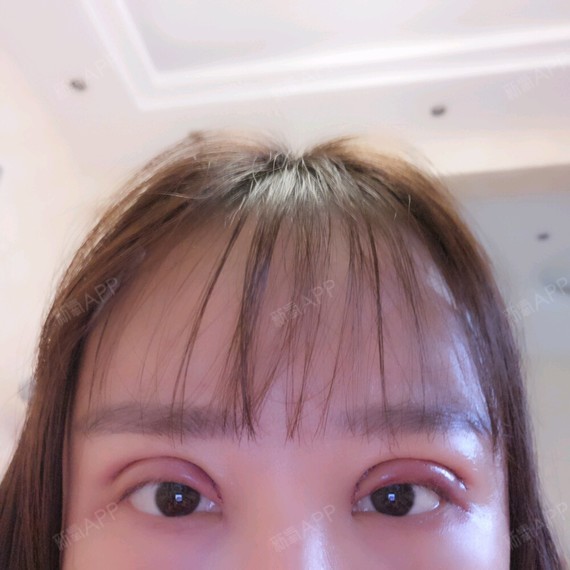 以前的双眼皮贴了几年导致眼皮上都松弛了 眼皮都有好几层呢