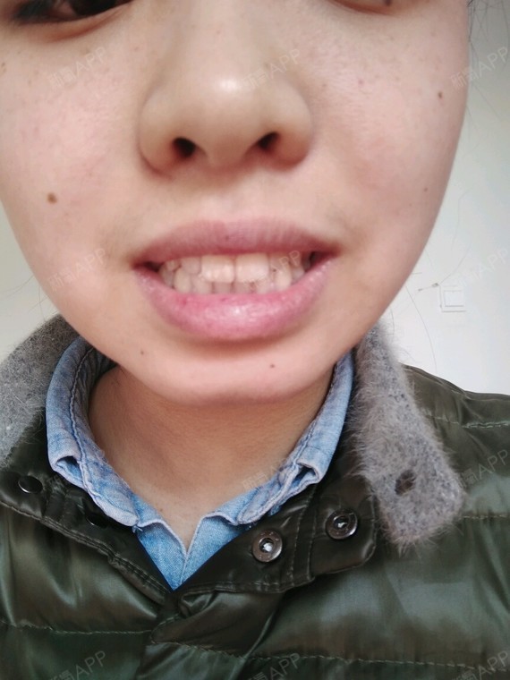 可能我牙齿也有点影响我的面部沦落,我有两颗鲍牙齿的图片难看鲍牙齿