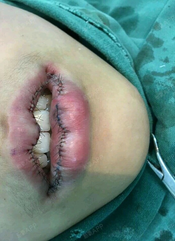 m唇手术