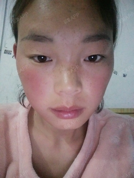 我又蒙脸沙已经有二十多年了现在想去掉但是有去了还会_圈子-新氧美容