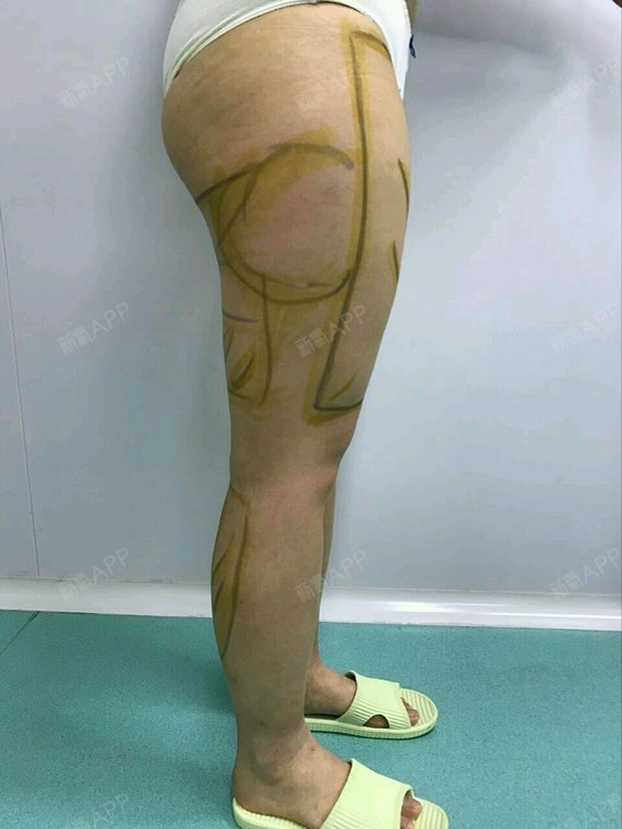 抽脂啊好好运动不就可以了吗以后会有后遗症的啊…天晓得我节过食吃过
