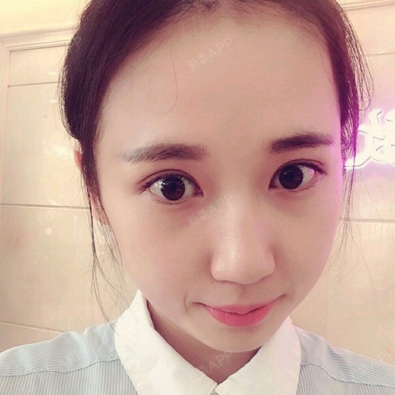 华仁做双眼皮半个月