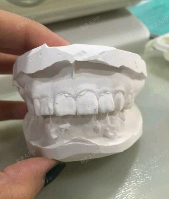 对比牙模牙齿咬合变化了很多很多以前是全覆盖的哟