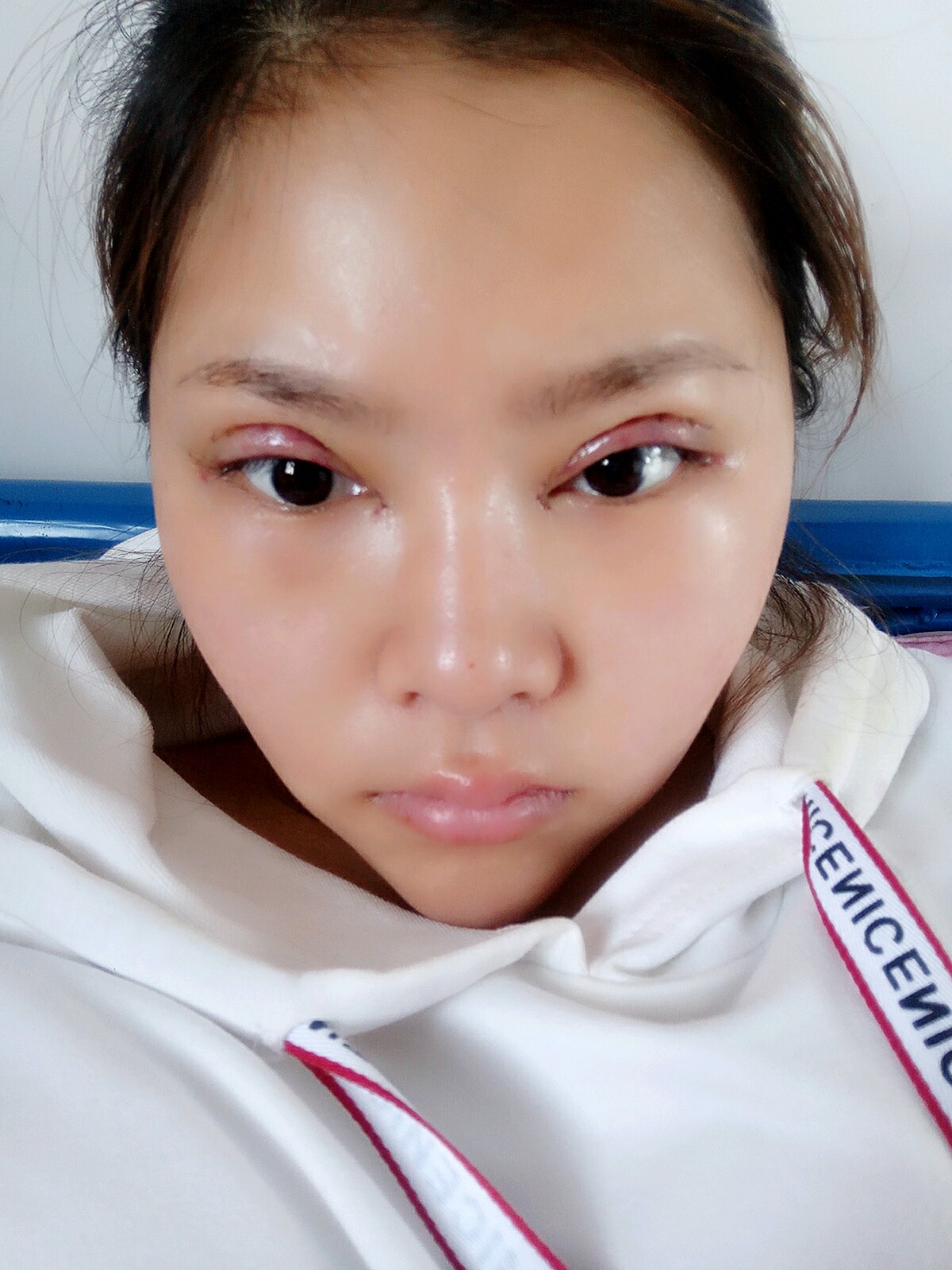 上海万安医疗美容门诊部开内眼角怎么样_恢复过程__8b