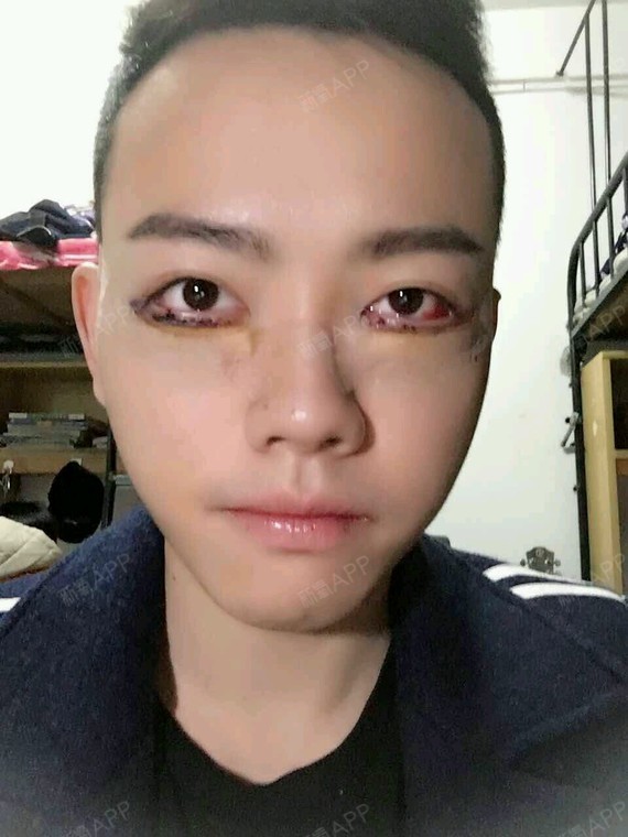 新氧- 让迎彤 | 眼部 | 眼袋 | 外切去眼袋 | 术后当自强 | 北京同城
