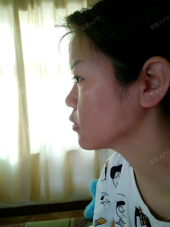 牙齿排列整齐,但两颗门牙有点前突,与上排_圈子-新氧美容整形