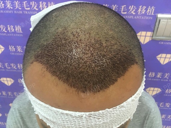 发获新生种植发际线第6天美丽日记-新氧美容整