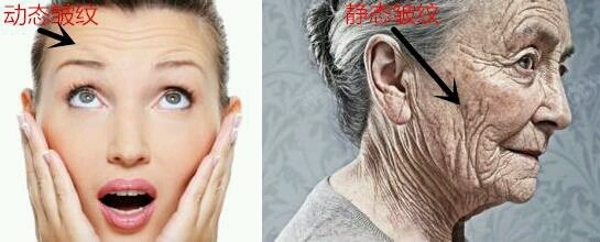 面部皱纹是老化的重要特征,其中当面部做表情时产生的